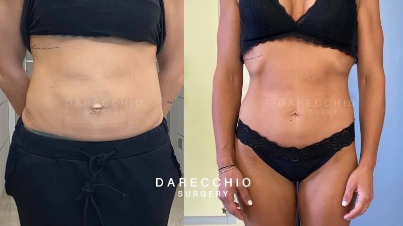 Diastasis intervention Dr. Darecchio