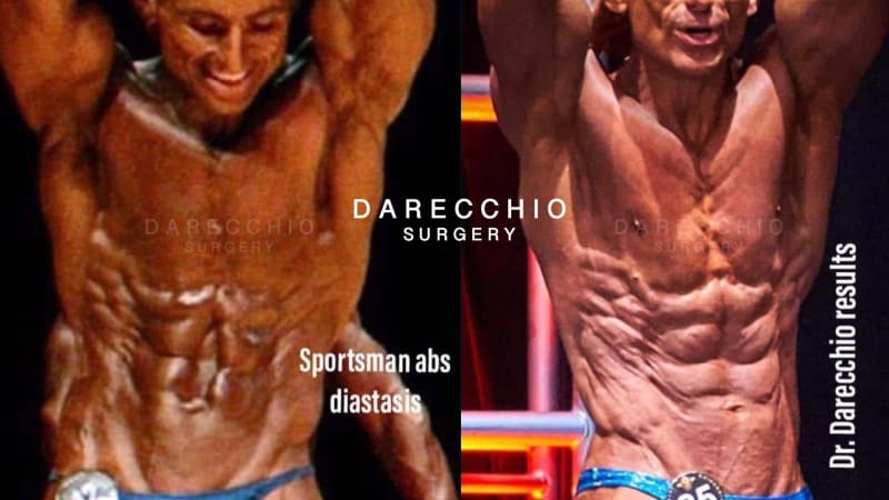 Champion de culturisme avec diastasis des muscles droits et hernie ombilicale.