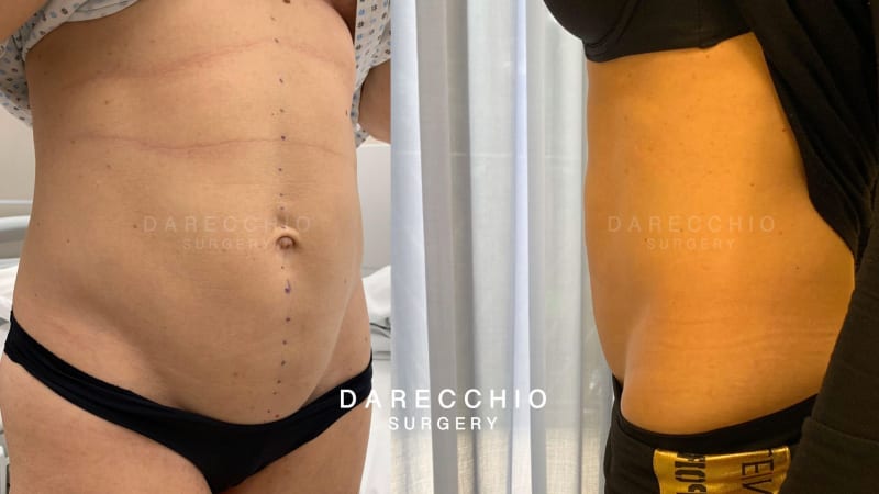 rectus abdominis diastasis extended to sub umbilical region