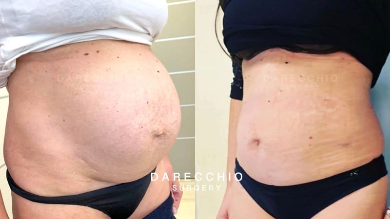 Severe rectus abdominis diastasis post pregnancy associated with stretch marks