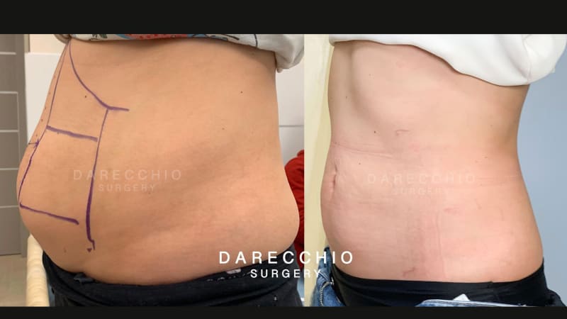 Fatiga localizada, laxitud de los tejidos y diástasis de rectos abdominales