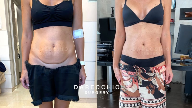 Excess skin and rectus abdominis diastasis and cesarean scar retraction