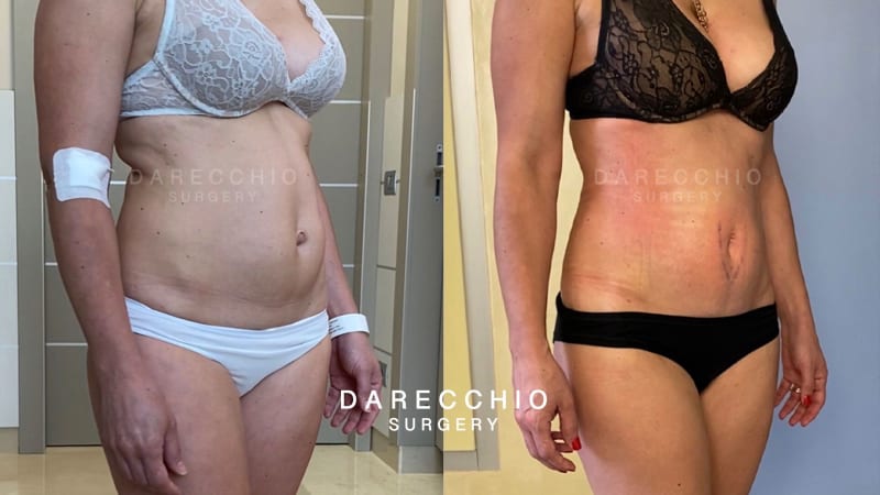 Umbilical hernia and rectus abdominis diastasis before and after 10 days - 2