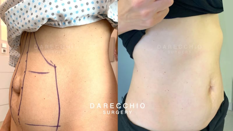 Advanced case of rectus abdominis diastasis associated with large umbilical hernia and numerous stretch marks (2)