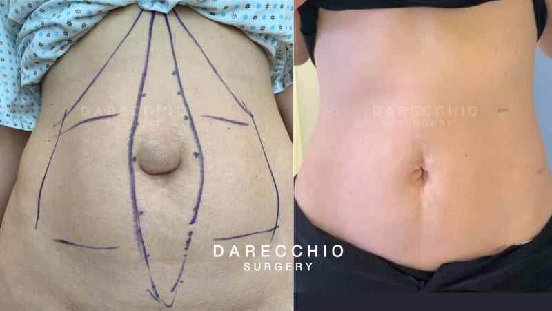 Advanced case of rectus abdominis diastasis associated with large umbilical hernia and numerous stretch marks (3)