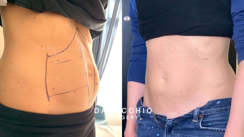 Incisions minimales et non visibles, abdomen plat, diastasis cicatrisé des muscles droits.