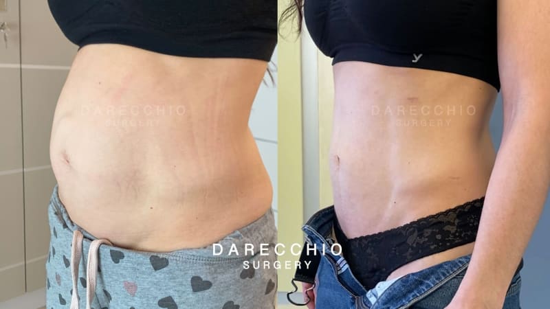 Hernia epigástrica y gran diástasis de rectos abdominales en un paciente delgado y atlético