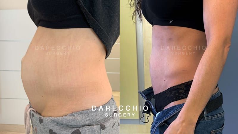 Diastasis Recti Treatment LA LIPO Derby