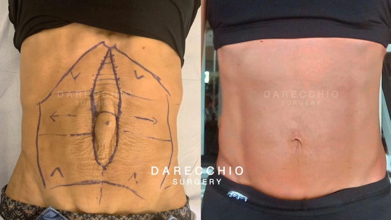 Limit case of large rectus abdominis diastasis and extreme cutaneous dystrophy