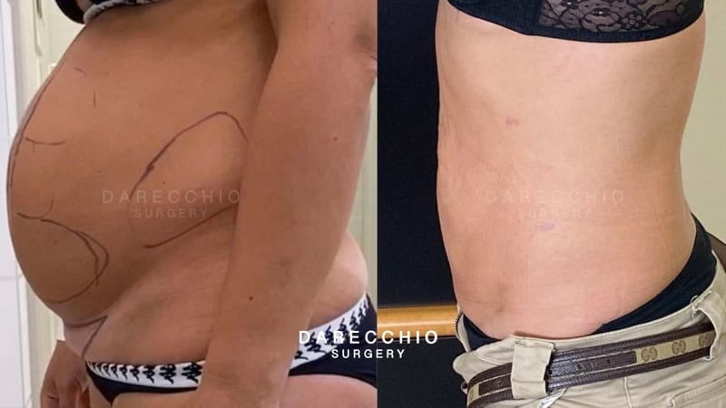 KALO Cosmetic Surgery - Rediscover Confidence👉【 #Tummy #Tuck 】for  Diastasis Recti . Are you tired of feeling self-conscious about your  postpartum belly bulge? 🤰🤱Pregnancy is a beautiful journey, but it can  leave