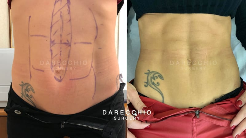 rectus abdominis diastasis in athletic patient