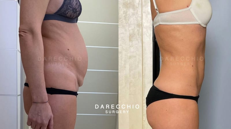 diástasis abdominal post embarazo, exceso de piel y retracción de cicatriz en cesárea