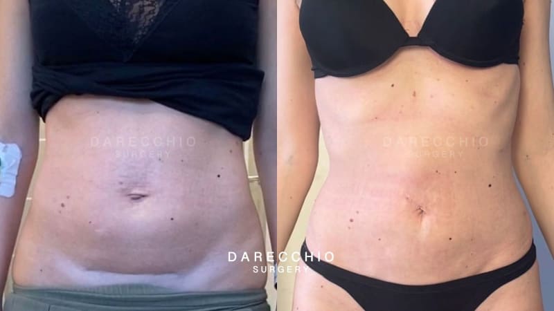 Scarring on cesarean section, subumbilical fat and diastasis