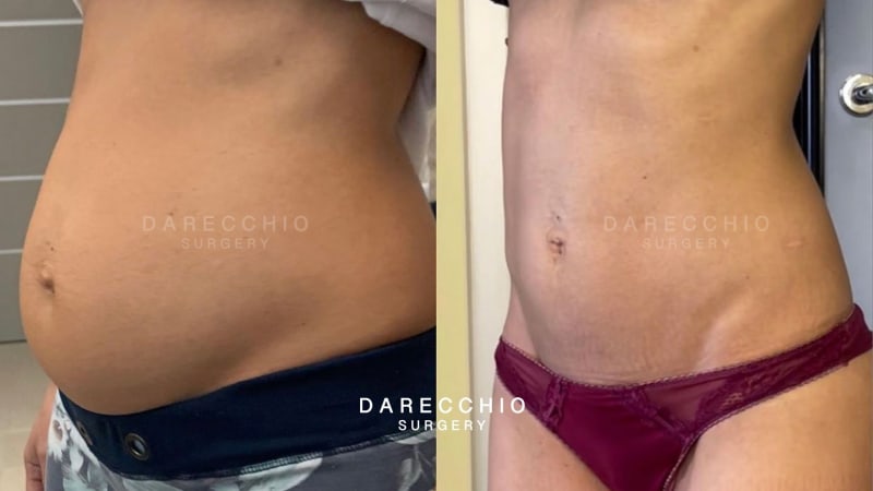 rectus abdominis diastasis post pregnancy