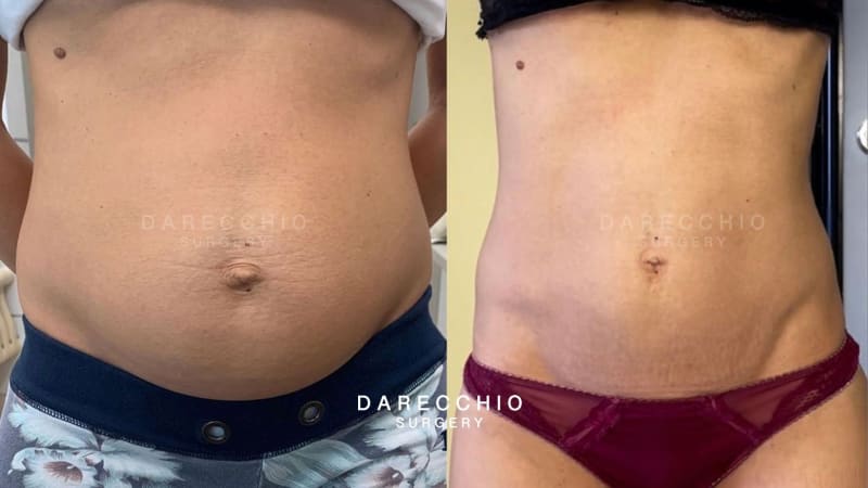 rectus abdominis diastasis post pregnancy (2)