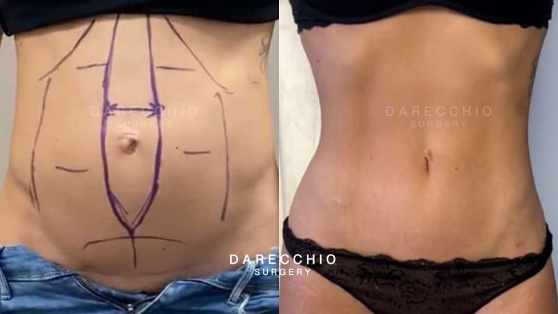 Young patient suffering from rectus abdominis diastasis post pregnancy