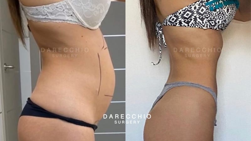 Young patient suffering from rectus abdominis diastasis post pregnancy