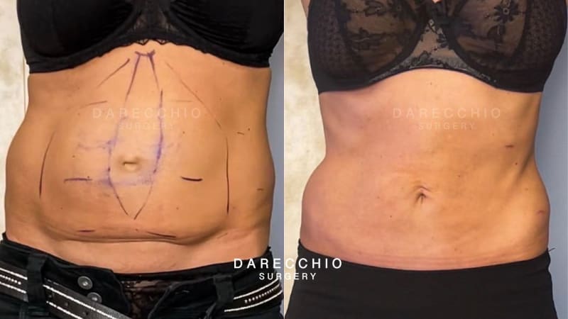 Scar retraction on cesarean and rectus abdominis diastasis, tissue laxity and excess skin (2)