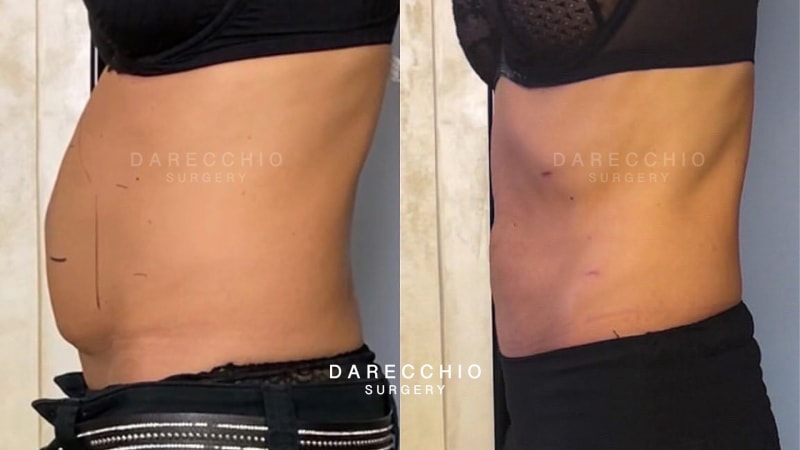 Scar retraction on cesarean and rectus abdominis diastasis, tissue laxity and excess skin