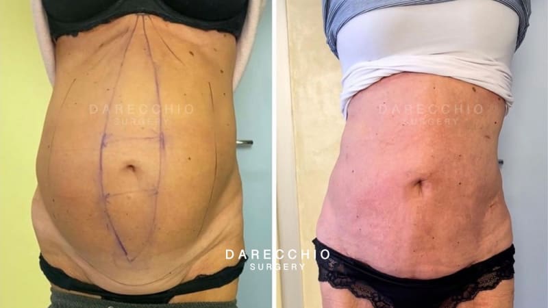 rectus abdominis diastasis depassé that affected the patient's life for years (2)