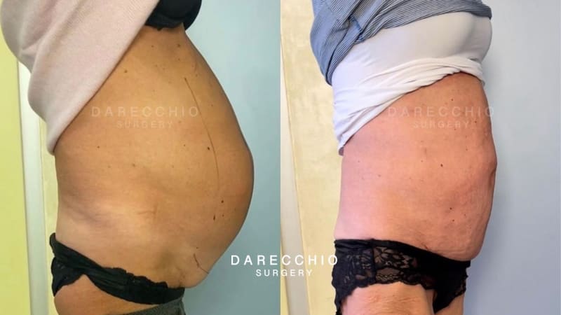 rectus abdominis diastasis depassé that affected the patient's life for years