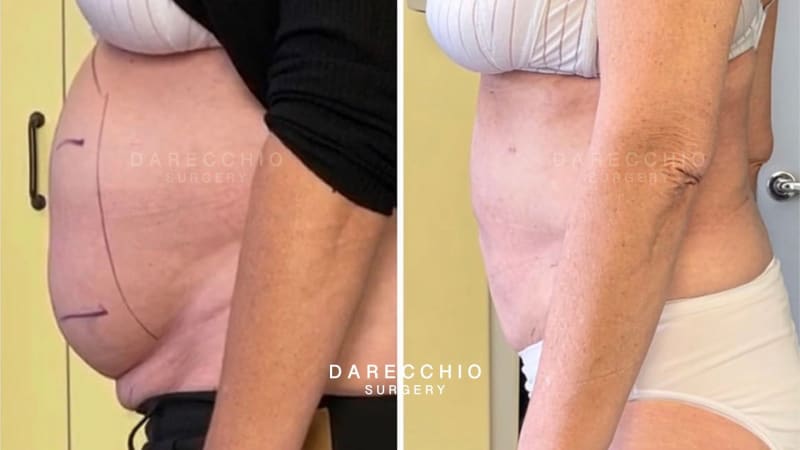 Laparocele, diástasis abdominal, exceso de piel y obesidad visceral