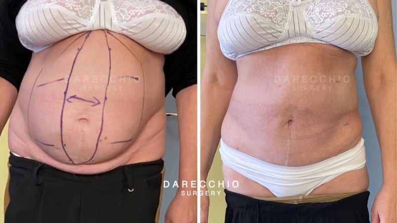 Diastasis Recti Treatment LA LIPO Derby