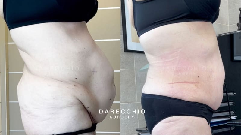 Large submebelical laparocele associated with rectus abdominis diastasis and skin-adipose laxity