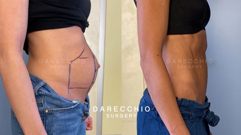 After pregnancy large diastasis in athletic patient