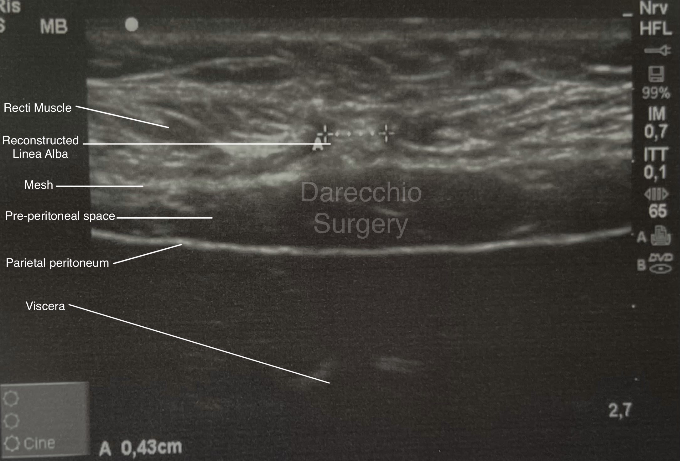 Contrôle par ultrasons après la reconstruction robotisée du diastasis recti du Dr. Darecchio après la reconstruction robotique du diastasis recti.