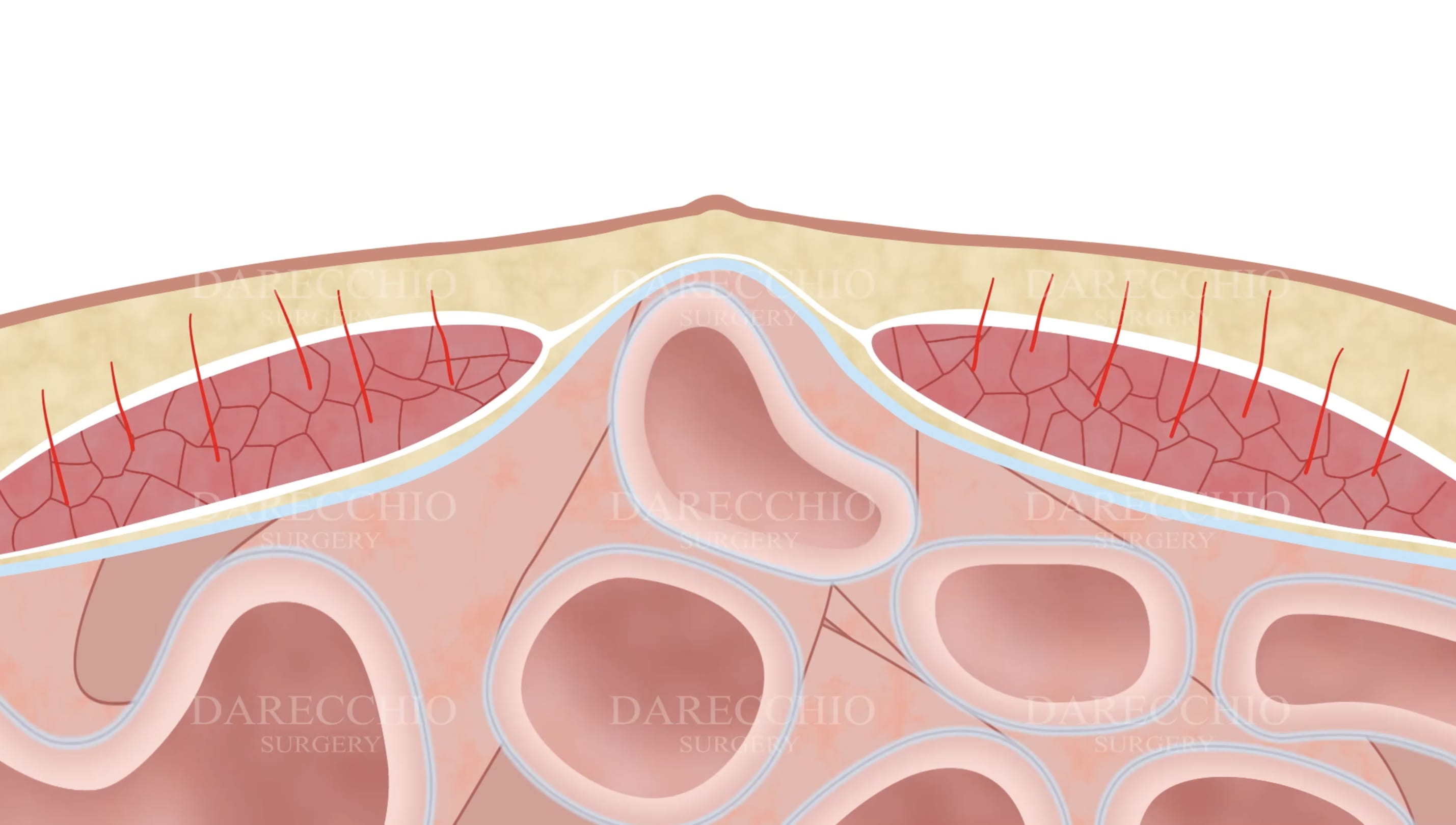 diastasis des grands droits physiopathologie