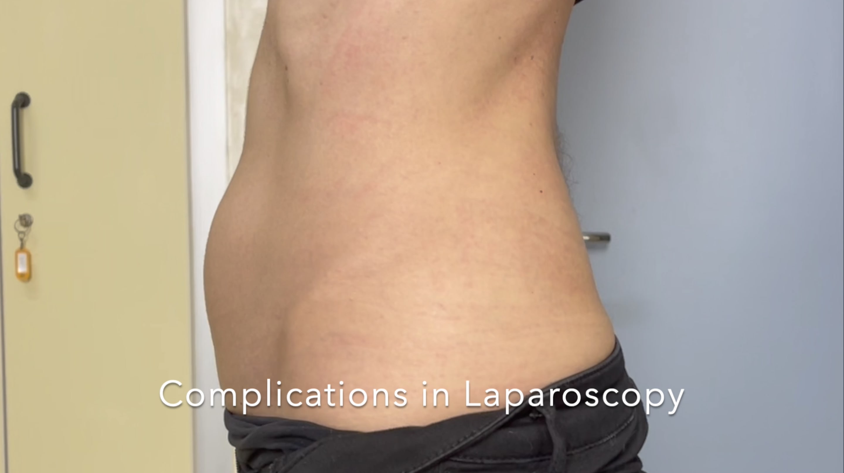 diastasis recti laparoscopy complications mesh