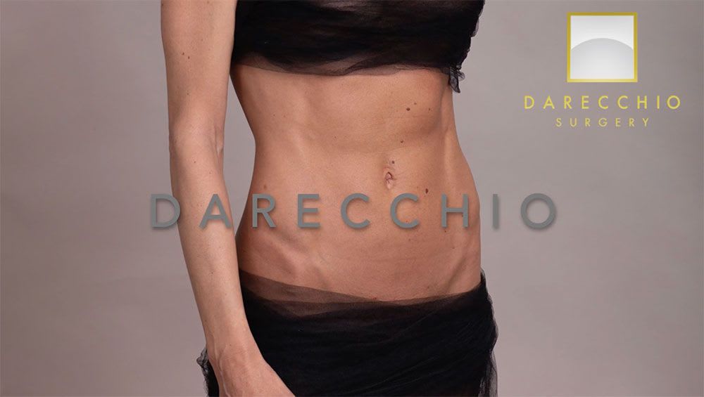 Dr. Darecchio procedimientos (reparación robótica de diastasis recti)