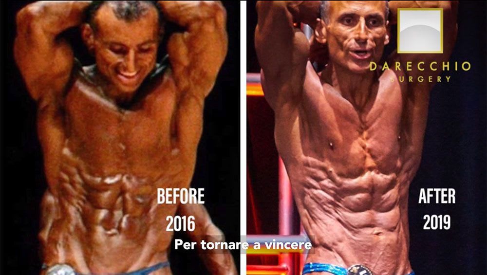 Diastasi dei muscoli retti nell’uomo sportivo. Chirurgia robotica Dr. Darecchio