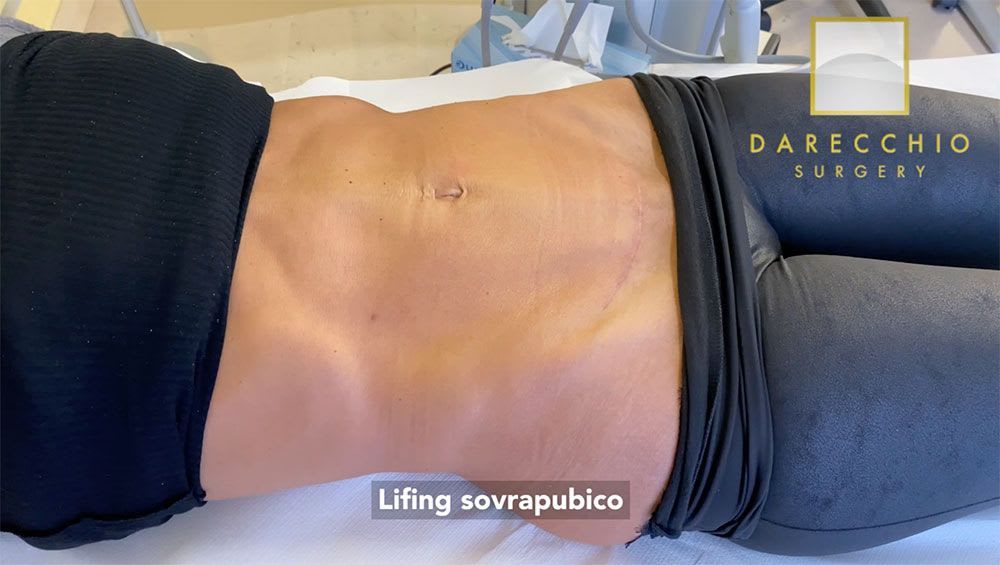 Result excess skin removal (suprapubic lifting)