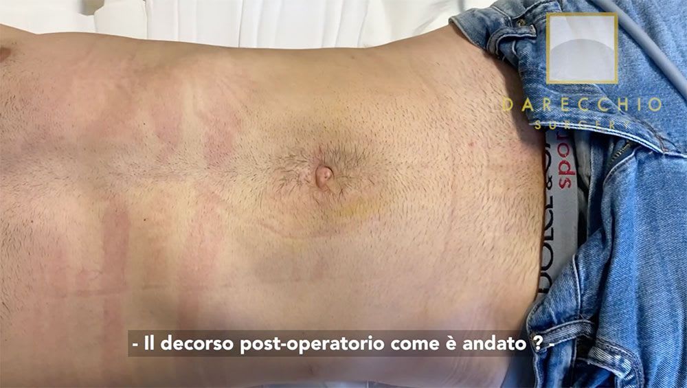 Cirugía robótica de hernia inguinal sin grandes incisiones, revisión