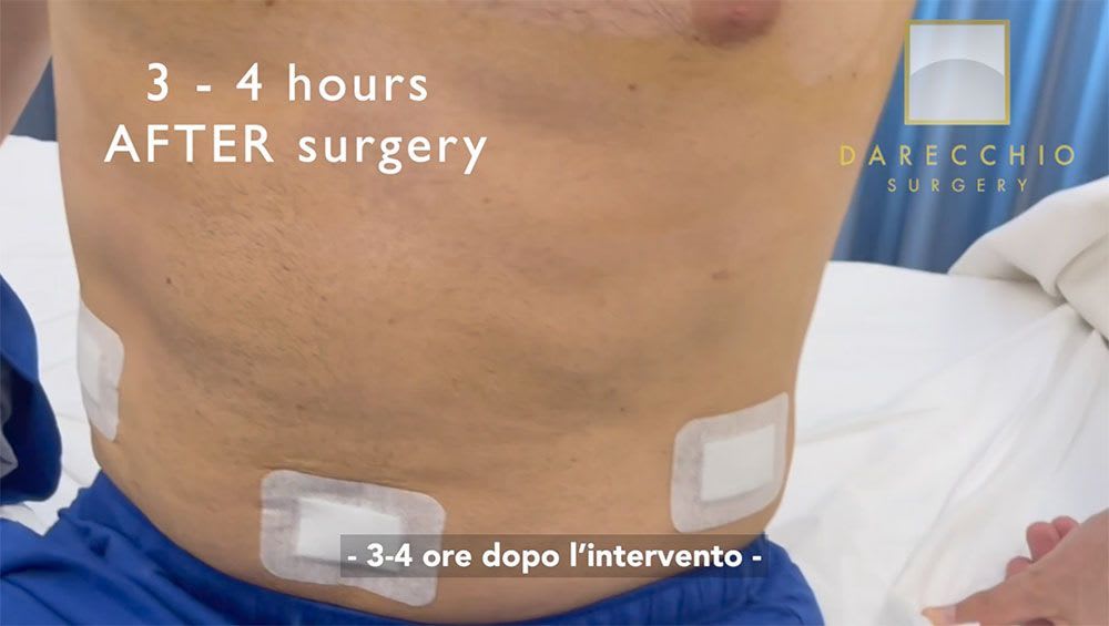 Cirugía robótica de hernia inguinal 3 horas después, revisión