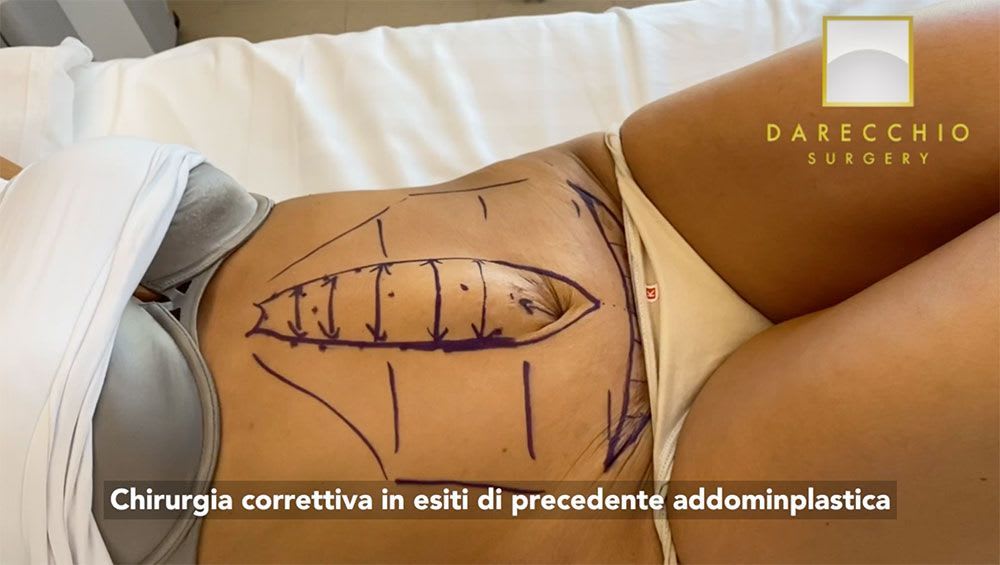 Corrective surgery in previous outcomes abdominoplasty (tummytuck)