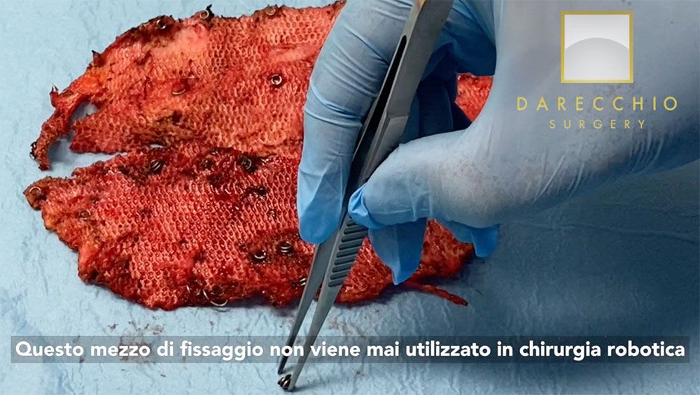 Repetición de la diástasis, dolor crónico y síndrome de adherencia tras la cirugía tradicional abdominoplastia y laparoscópica.