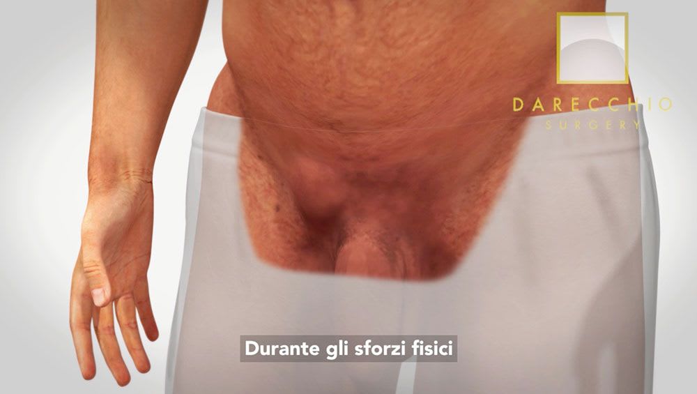 Signs and symptoms of inguinal hernia. The most modern interventions