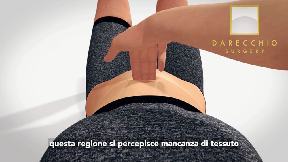 diástasis abdominal: signos, síntomas e intervención Dr. Darecchio