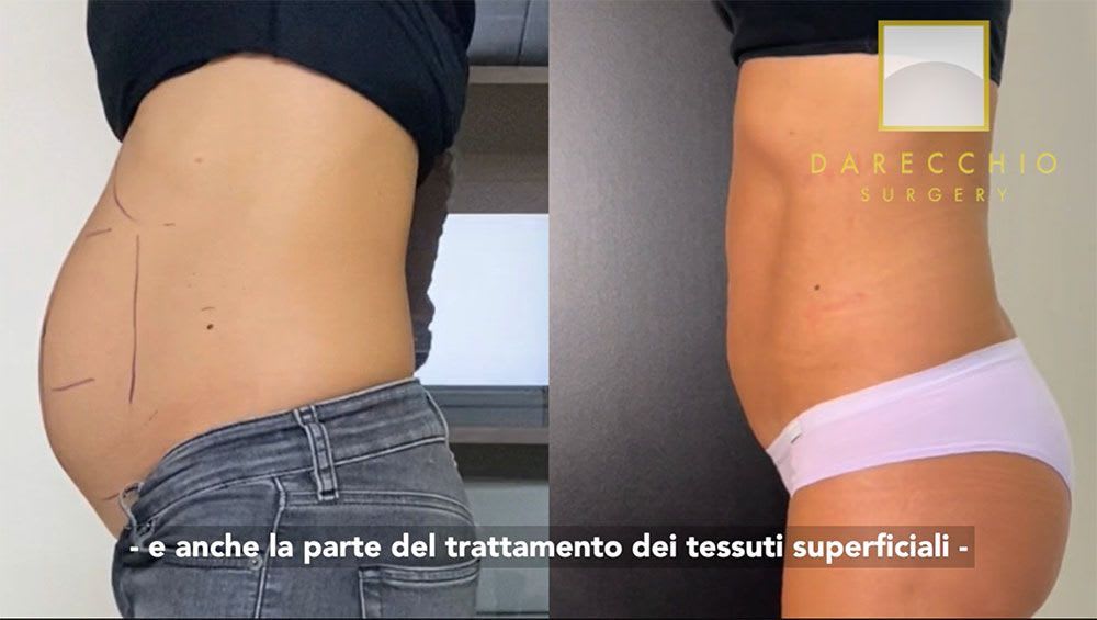 Chirurgie du diastasis Dr. Darecchio, entretien après 5 mois