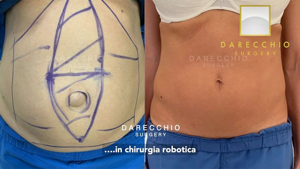 Diastasis des muscles droits, hernie ombilicale, intervention robotique