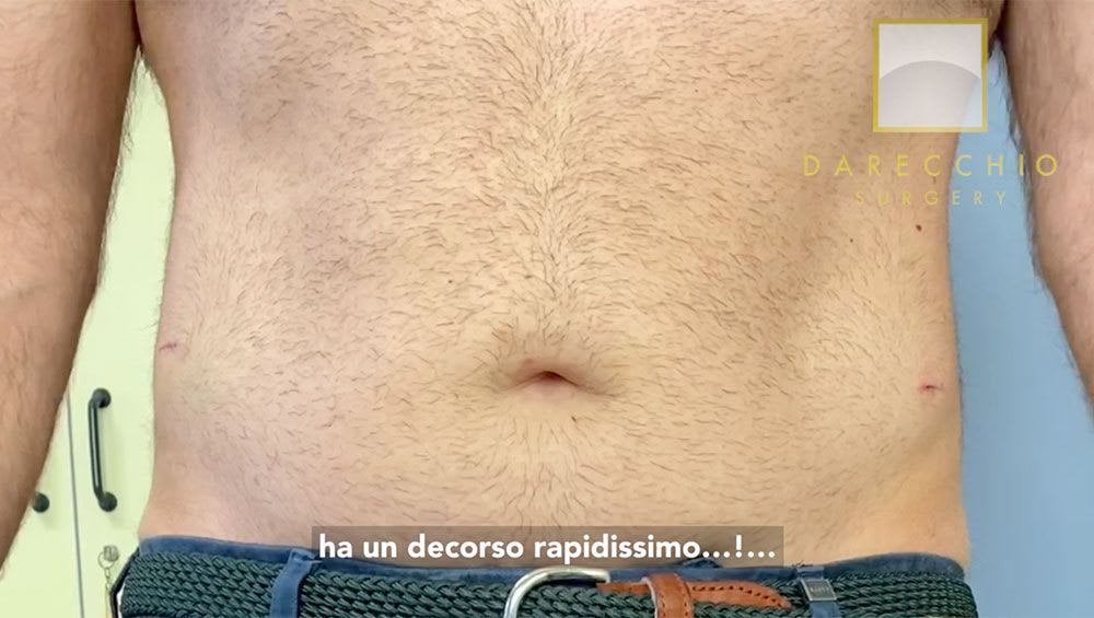 Revisión de la moderna cirugía robótica de la hernia inguinal