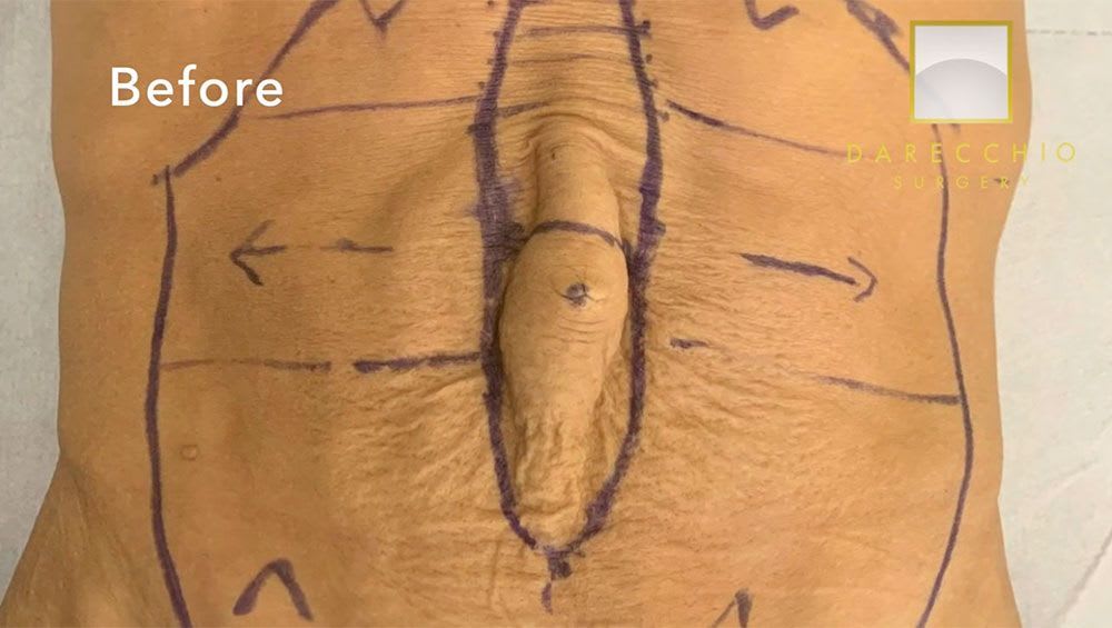 Diastasis excès de peau Chirurgie robotique (signes et symptômes péristaltisme)