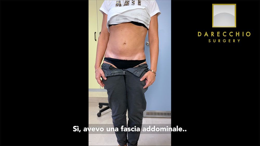 Surgery diastasis recti rapid healing and excellent aesthetic result, interview