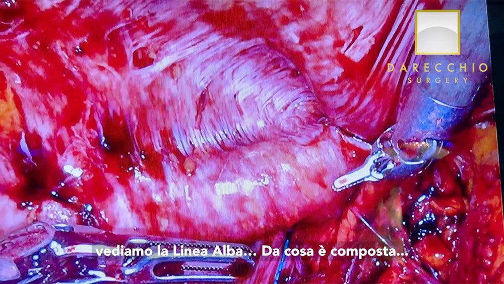 Anatomy of linea alba, diastasis robotic surgery