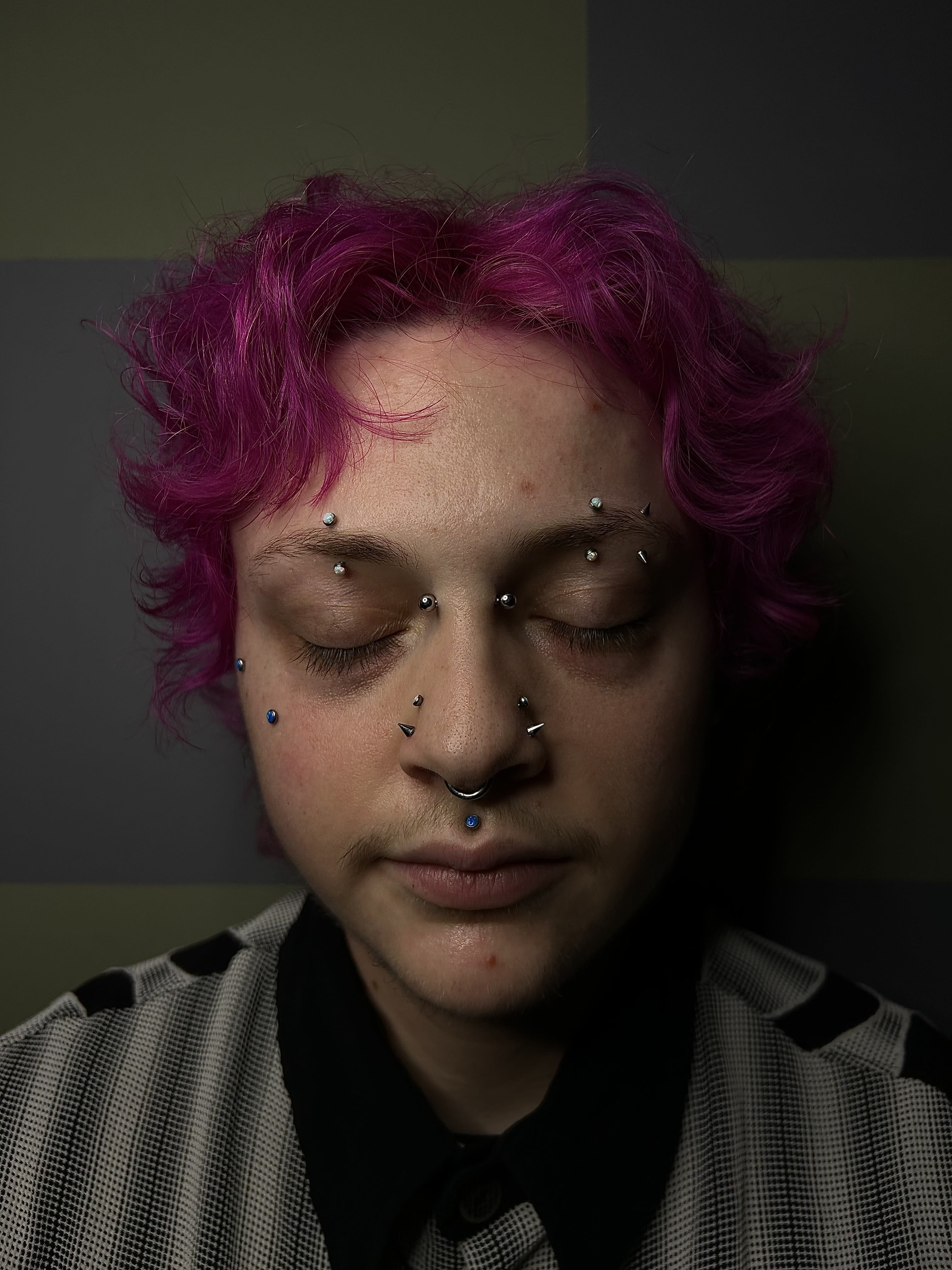 Healed cheek dermals, inner brows, philtrum, and fresh bridge. 