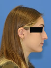 Before Rhinoplasty before and after