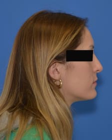 After Rhinoplasty before and after